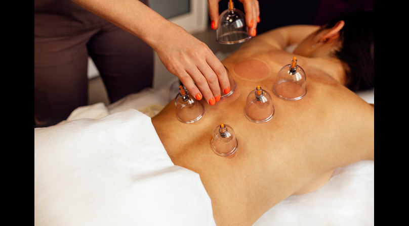 starling-holistic-licensed-image-123rf-cupping-therapy-202605969-m-normal-none_orig--1-