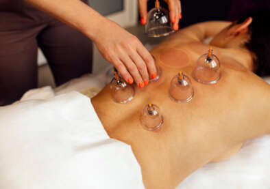 starling-holistic-licensed-image-123rf-cupping-therapy-202605969-m-normal-none_orig (1)